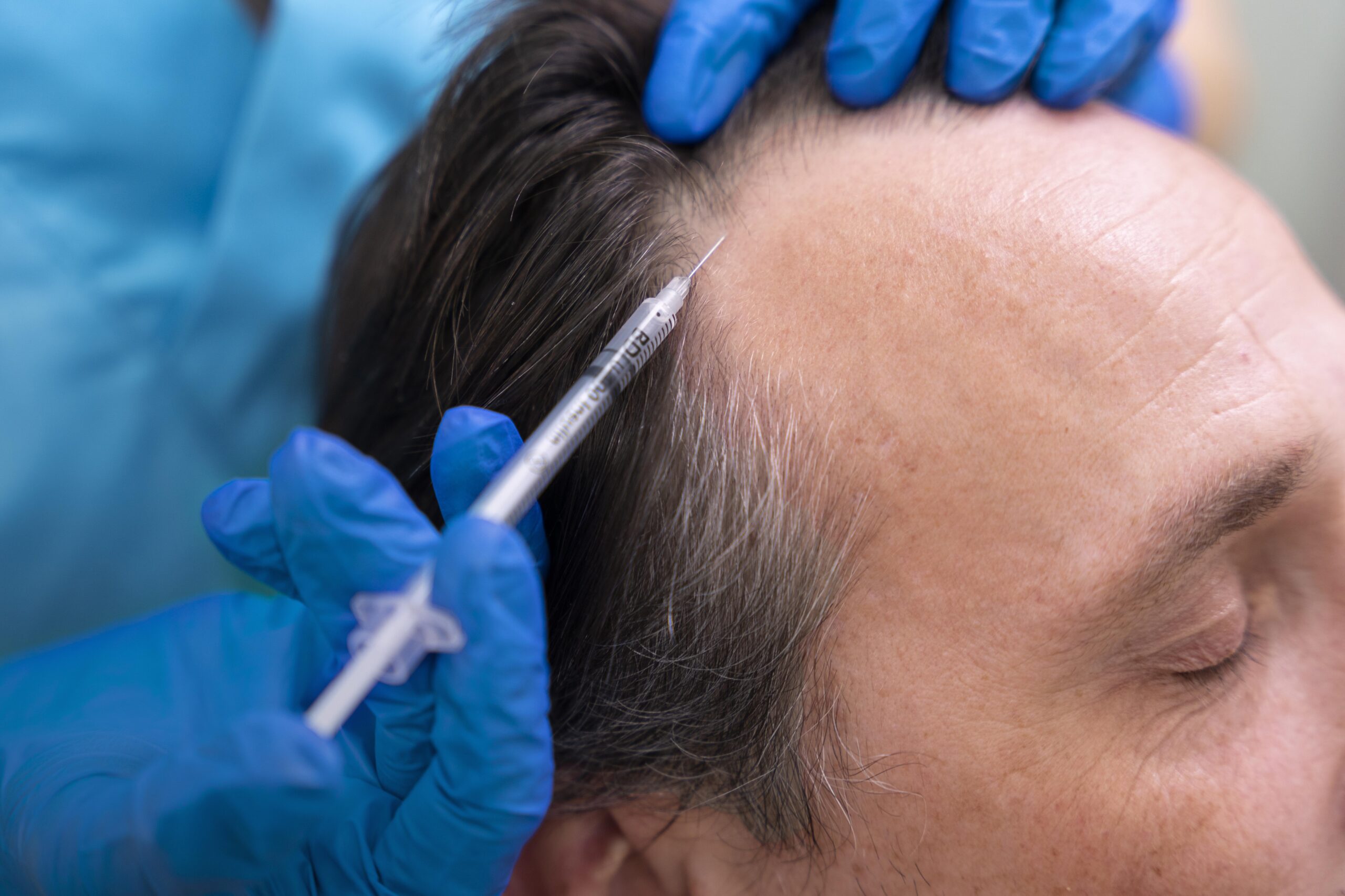 Scalp PRP Therapy