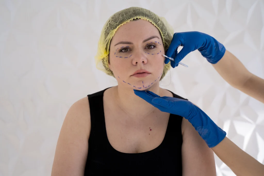 Rhinomodelation with Filler